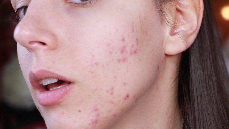 Acne is one of the most common skin problems these days