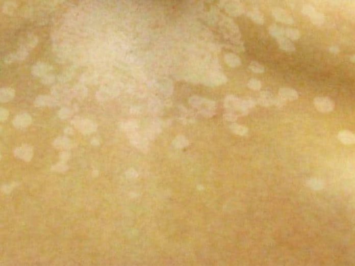 Vitiligo Leukoderma