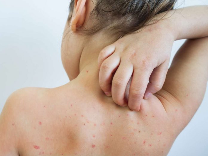 Measles outbreak in Govandi area